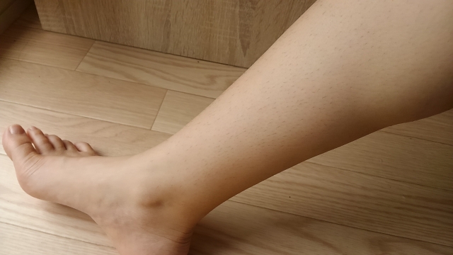 深部静脈血栓症の看護